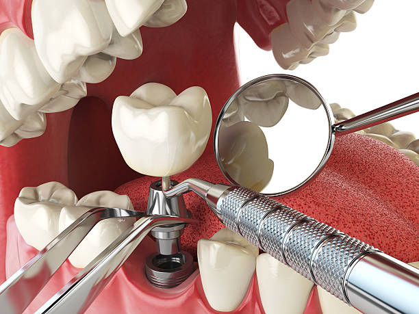 Best Urgent Tooth Repair  in Lacoste, TX